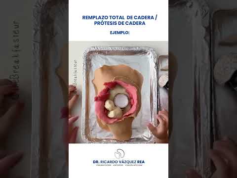 Remplazo total de cadera (ejemplo) 😃