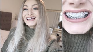 I KNOW WHEN I&#39;M GETTING MY BRACES OFF | 7 Month Braces Update