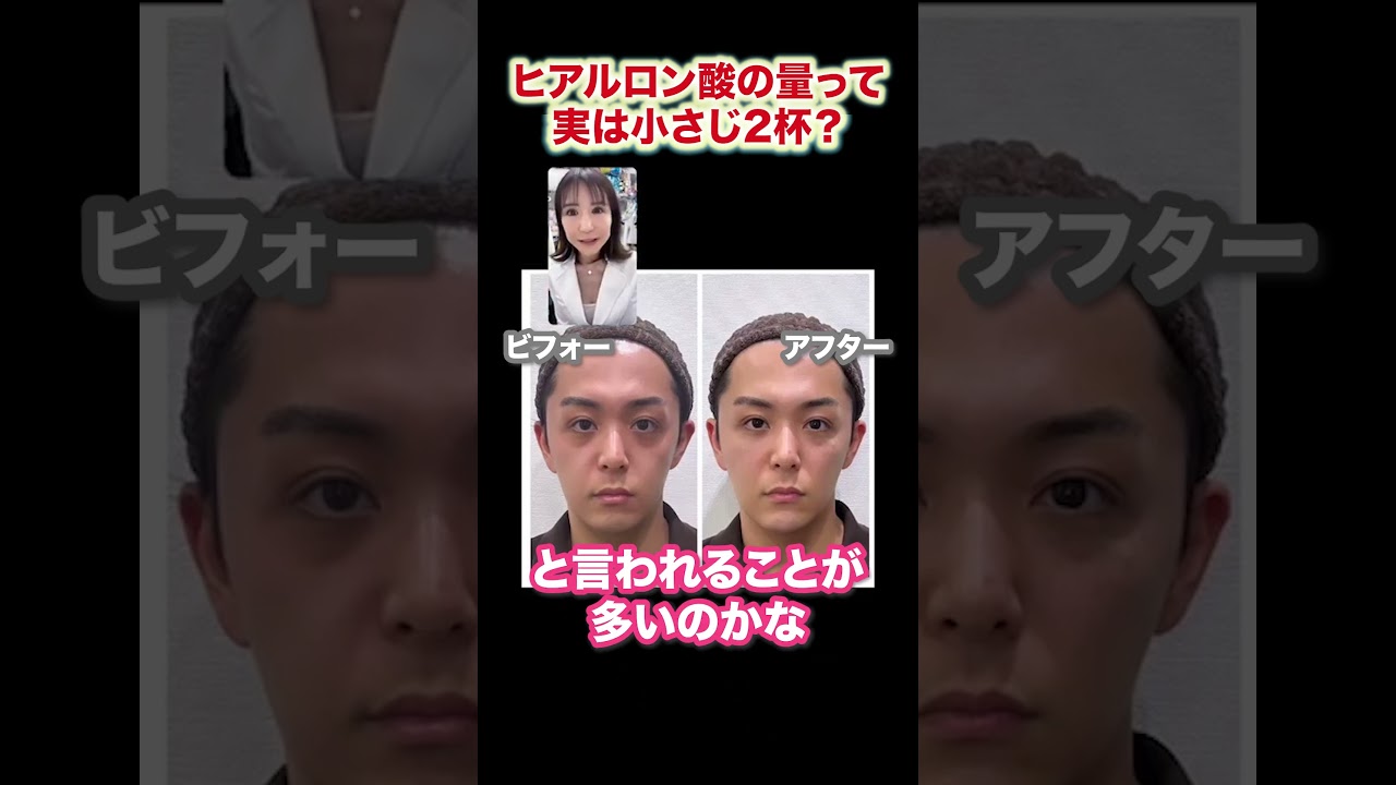 【切り抜き】 ヒアルロン酸の量って実は小さじ2杯？#shorts #しのぶ皮膚科 #ヒアルロン酸 #美容整形 #美容医療 #美容