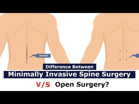 Open Fusion vs Minimally Invasive Spine | Dr. Ajay Kothari