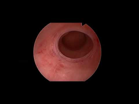 Subtypes of T-shaped uterus: should we update the current classification?