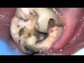 Monster cavity under filling- Can tooth be saved?