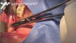 Extraccion de Bolas de bichat Dr Calvo Diplomado cirugia periodontal UNMSM 2013