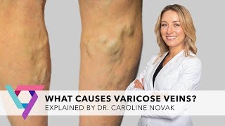 What Causes Varicose Veins | Top Vein Expert