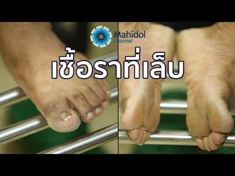 ซื้อ akrustal จากผู้ผลิต ดอกคาโมไมล์และ celandine ในโรคสะเก็ดเงิน