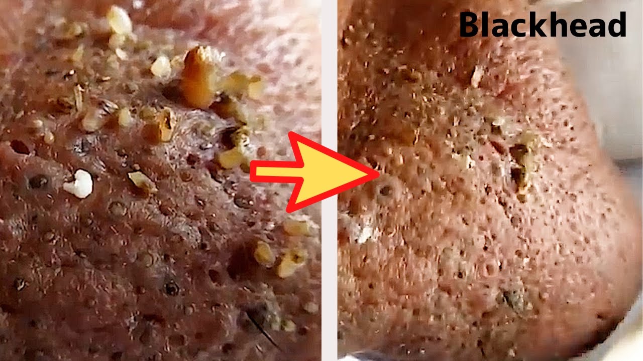 【角栓除去】極太！大量のニキビを芯出しするのって気持ちいい／Blackhead Removal Show