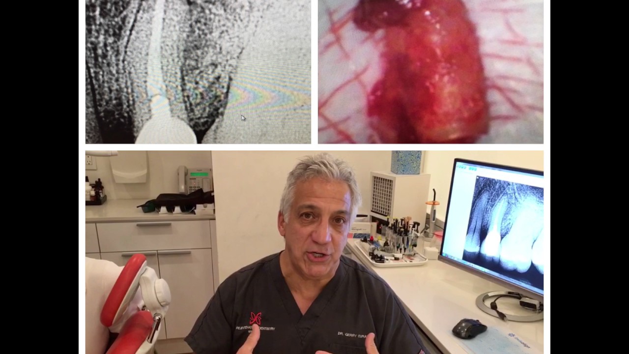 The truth about dental bone cavitations - YouTube