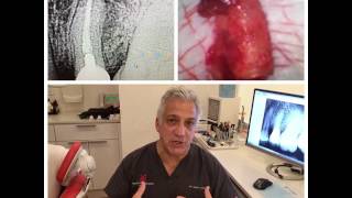 The truth about dental bone cavitations