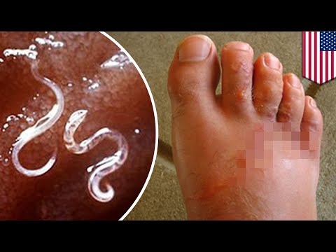 az emberi test vérzői elleni küzdelem papilloma száj icd 10