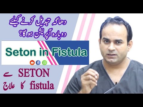 Seton Treatment of Fistula in Ano | Surgeon Dr Imtiaz Hussain