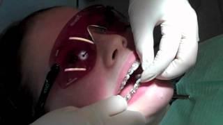 preview picture of video 'Fitting fixed braces-Wetherby Orthodontics'