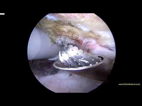 R Shoulder Bursal Side Rotator Cuff Tear with Repair 2016 11142016 BM Video