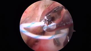 Arthroscopic Rotator Cuff Repair