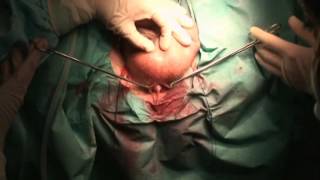 Incontinencia Urinaria con Malla Titanizada TILOOP MALE