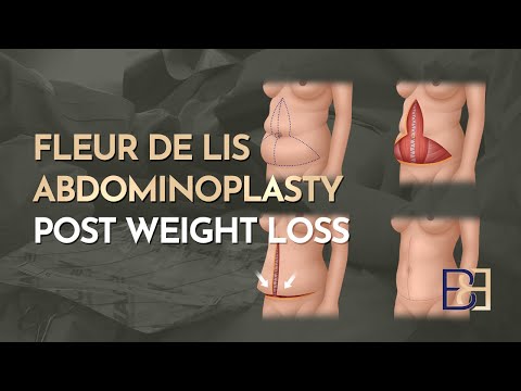Fleur‑de‑Lis Abdominoplasty (post‑weight loss) explained