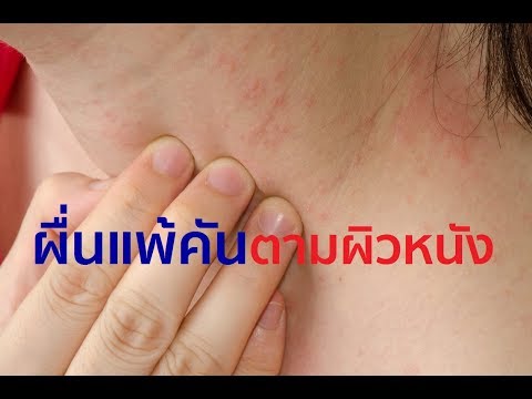 ชุดของ neurodermatitis รักษากลาก, การรักษาด้วยโอโซน