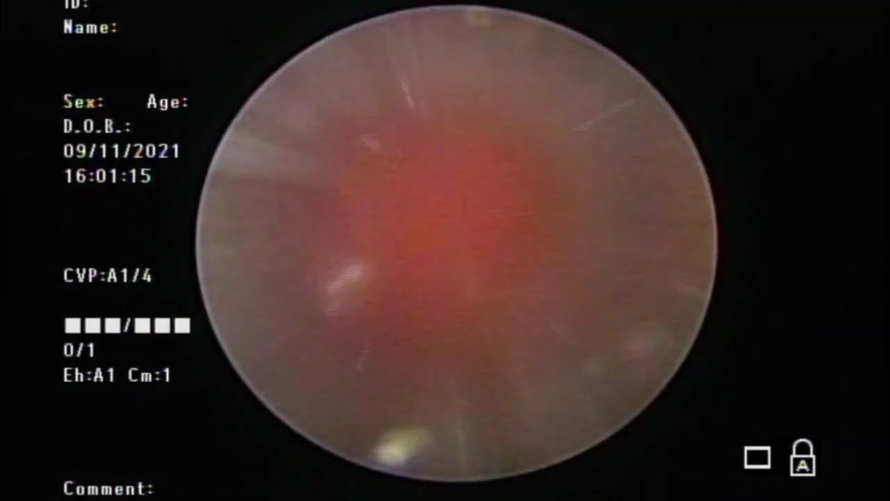 Percutaneous Nephrolithotomy