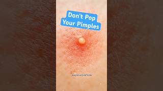 Download lagu Why Popping Pimples Makes Them Worse mp3