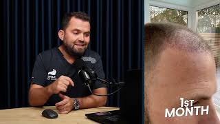 9-Month Hair Transplant Results (3600 Grafts) | Smile Hair Clinic – Dr. Mehmet Erdoğan