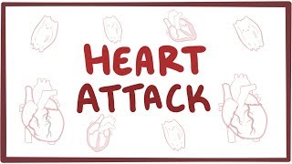 Heart attack (acute myocardial infarction) - causes, symptoms, diagnosis, treatment, pathology