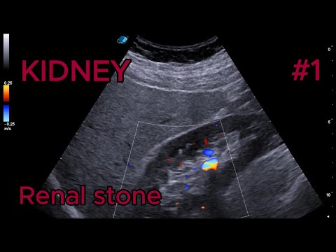 Renal stone video preview