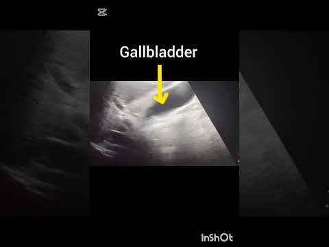 Ultrasound Abdomen showing Normal Gallbladder#ultrasoundmadeeasy86#radiology#sonography#viralshorts
