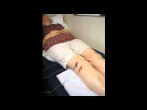 Acupuncture Treatment Of Arthritis