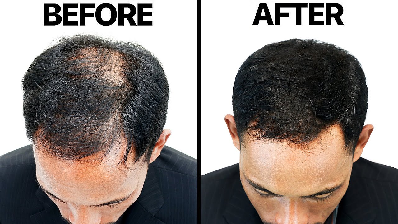 Finasteride (Propecia) For Hair Loss