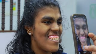 Correction d'un sourire gingival important et de lèvres fines | Consultation