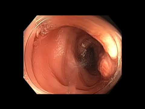 Coloscopie: résection d'un polype pédiculé du côlon sigmoïde