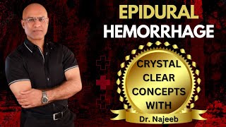 Epidural Hemorrhage | Anatomical | Features & Pathophysiology | Dr Najeeb