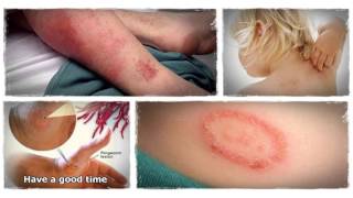 how to get rid of ringworm fast