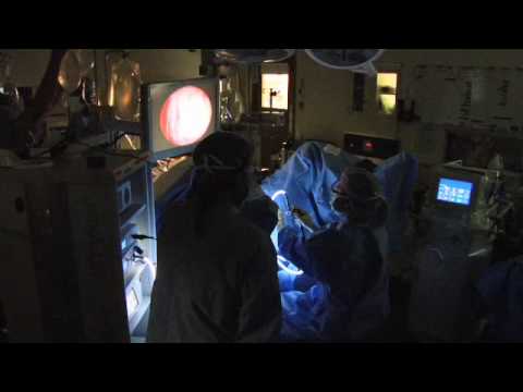 Holmium Laser for BPH-Mayo Clinic