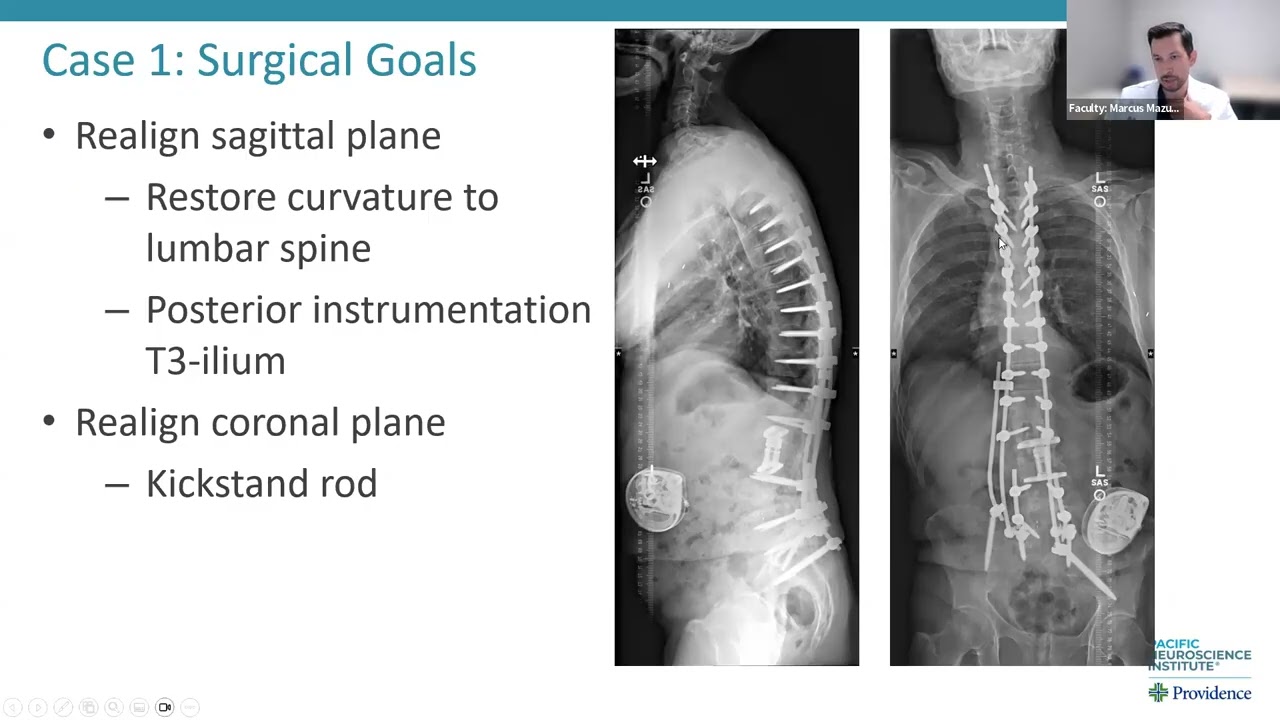 Diagnosing & Treating Adult Spinal Deformity, Neuroscience Grand Rounds, September 2025