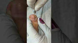 Ep_8166 Foot nail skin removal 👣 This is what made me get pus 😄 (clip from Thailand)