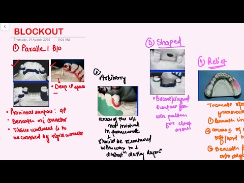 Blockouts RPD Prosthodontics 