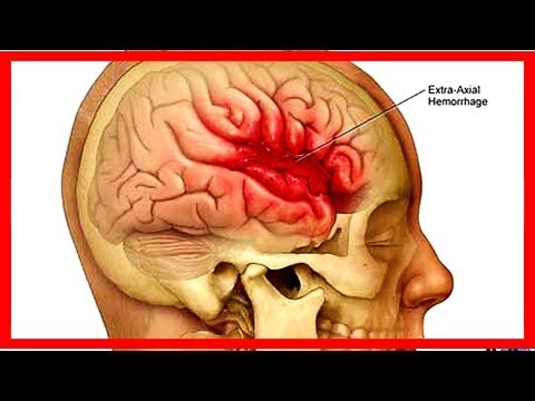 Cauterizzare il mal di schiena Se è possibile raddrizzare vertebre toraciche