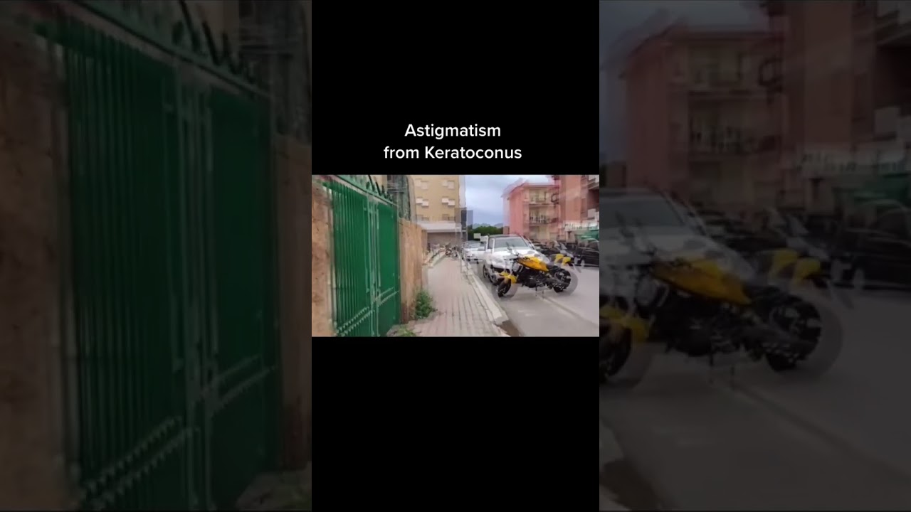 Keratoconus Vision Simulation #keratoconus #shorts Treatment info www.KeratoconusInserts.com