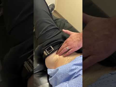 Manual Release of Lateral Femoral Cutaneous Nerve