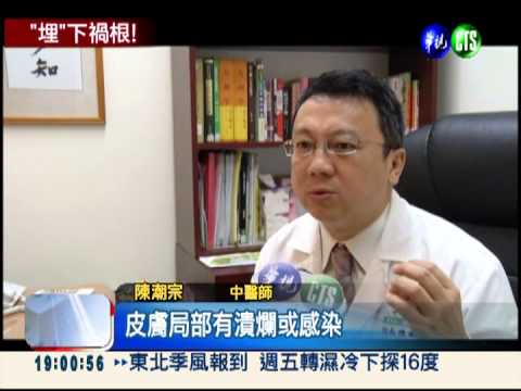 埋線超過20針 循環變慢難享"瘦"!