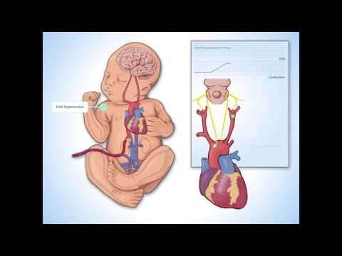 Late Decelerations - Fundamentals of Fetal Health Surveillance