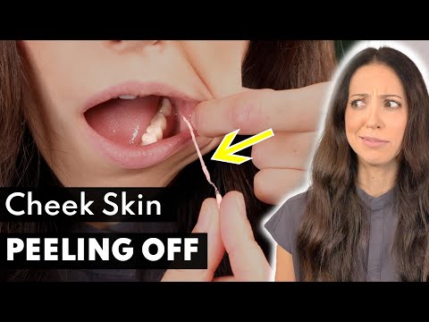 5 Reasons The Inside Of Your CHEEKS are Peeling Off (Explaining the Ingredient SLS)