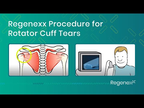 Regenexx Procedures for Shoulder Injuries and Arthritis - Regenexx
