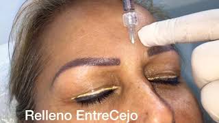 Relleno EntreCejo Ac.Hialuronico #efectoVesalio