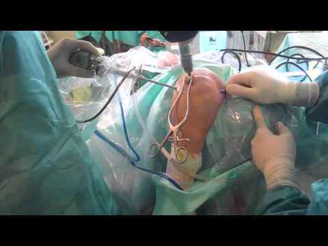 Hahn-Steinthal fracture arthroscopy