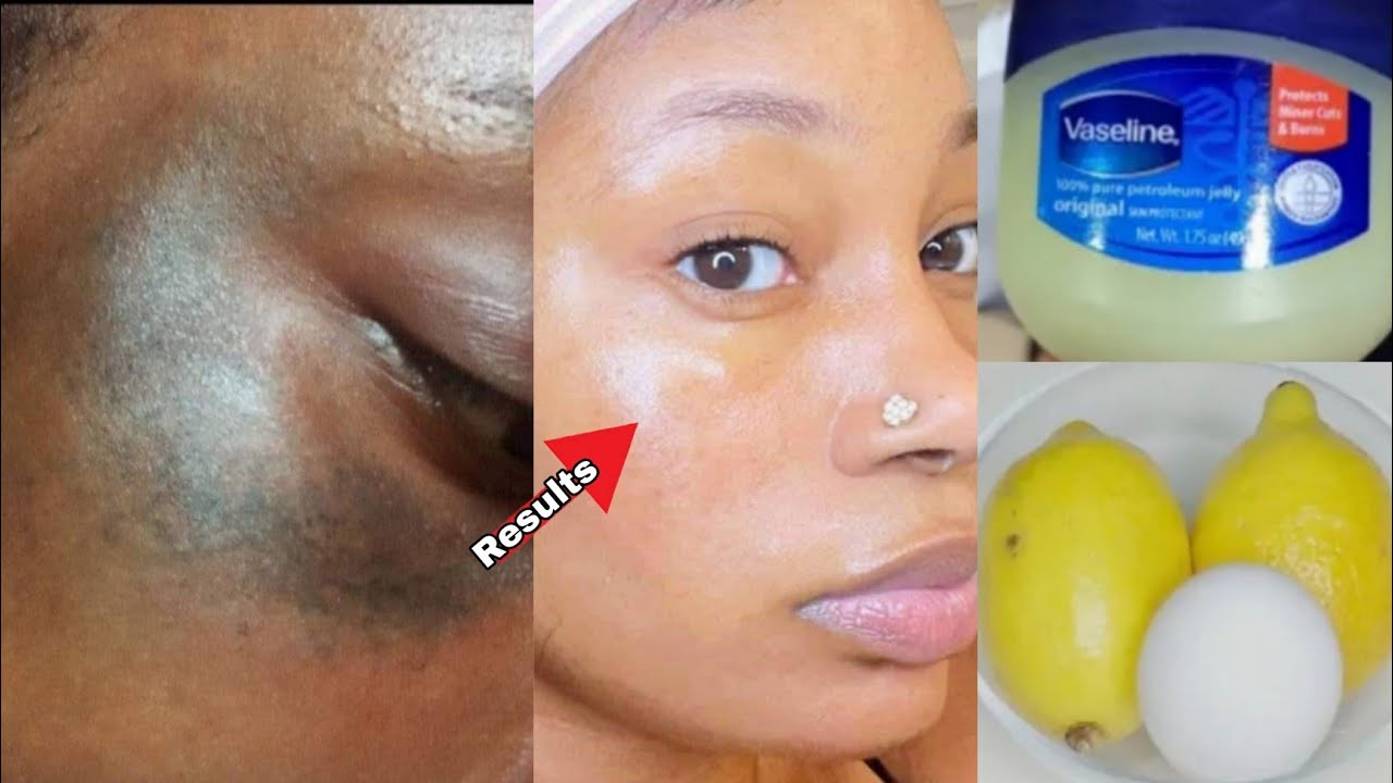 LOOK FOREVER 16! USING VASELINE, LEMON and Egg White. BABY FACE. to remove sunburn pigmentation