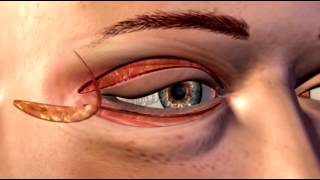 Cosmetic Eye and Eyelid Surgery - 3D Medical Animation || ABP ©