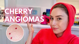 Cherry Angiomas: How To Treat Them + Demo! | Dr. Shereene Idriss