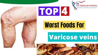 Varicose veins diet | Top 4 Food you Should Avoid if You Have Varicose veins