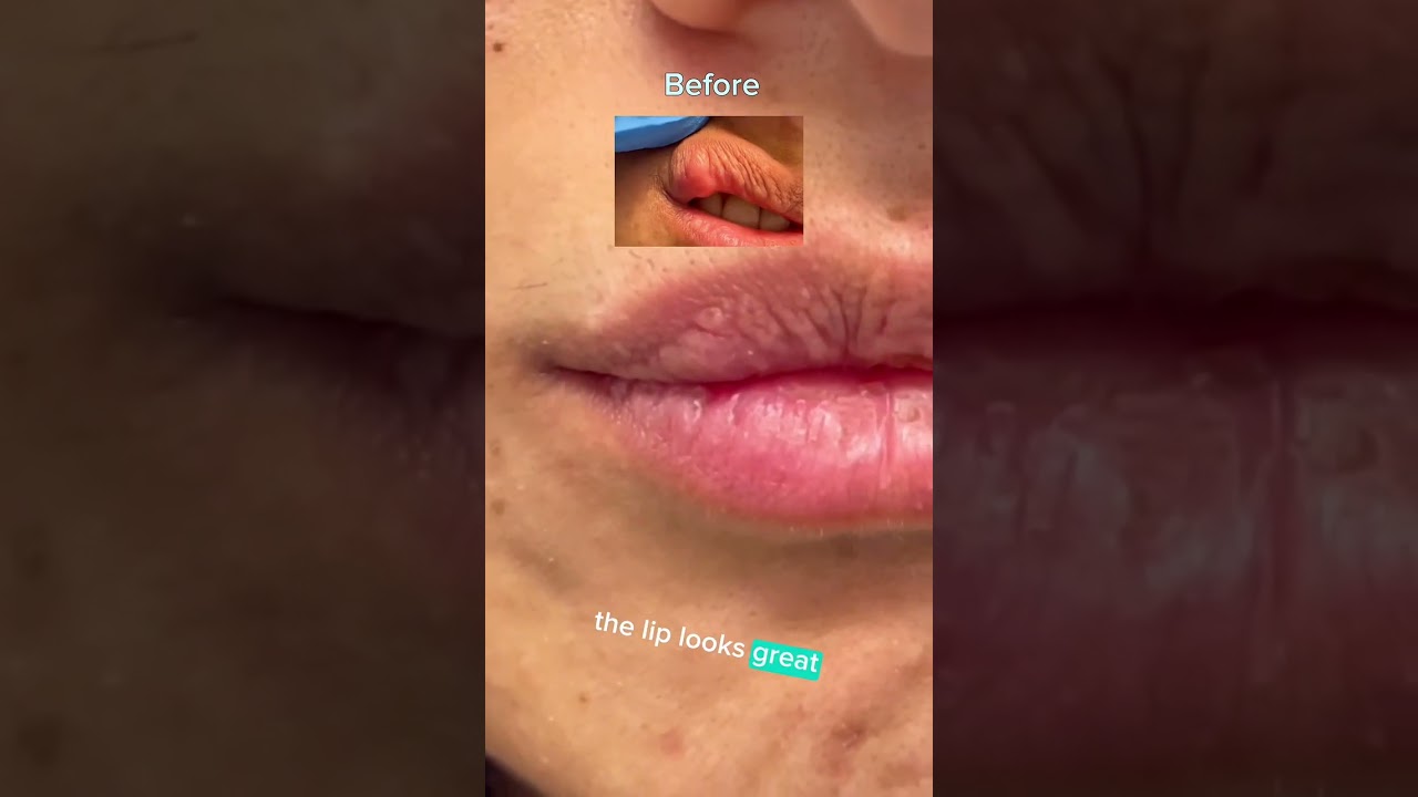LIP SCAR REVISION - DR. TANVEER JANJUA- NEW JERSEY